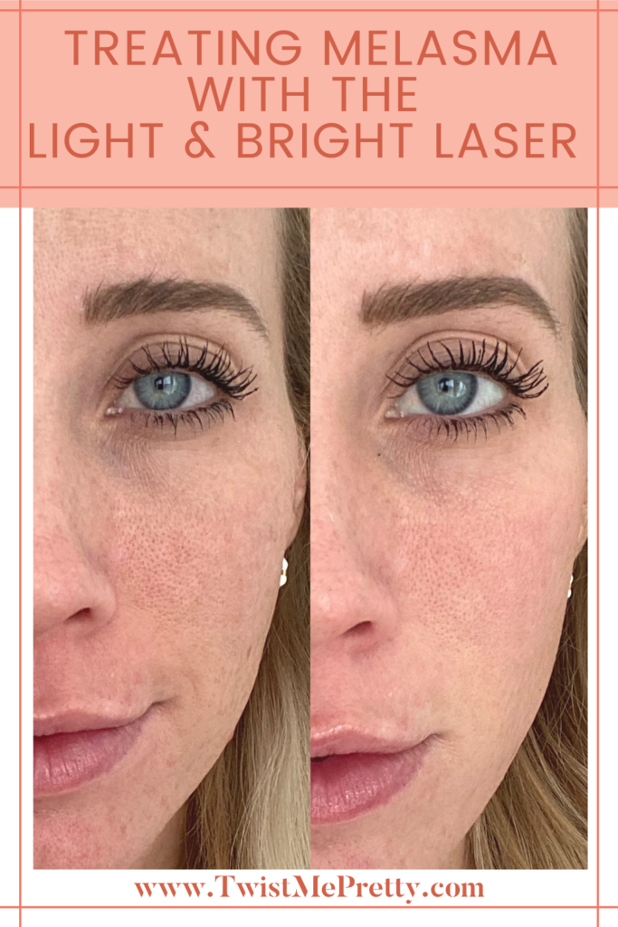 Treating Melasma with The Light and Bright Laser Twist Me Pretty