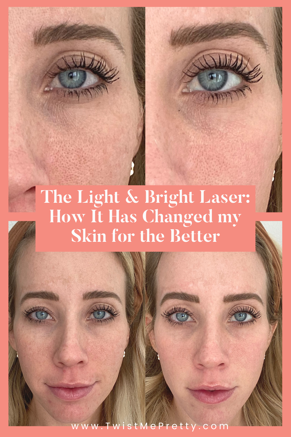 Treating Melasma with The Light and Bright Laser Twist Me Pretty