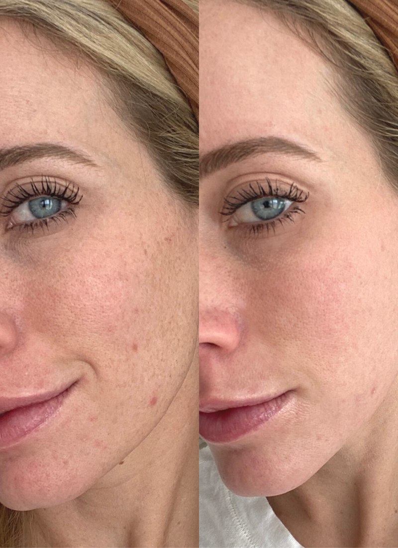 How I used a new treatment for my melasma www.twistmepretty.com