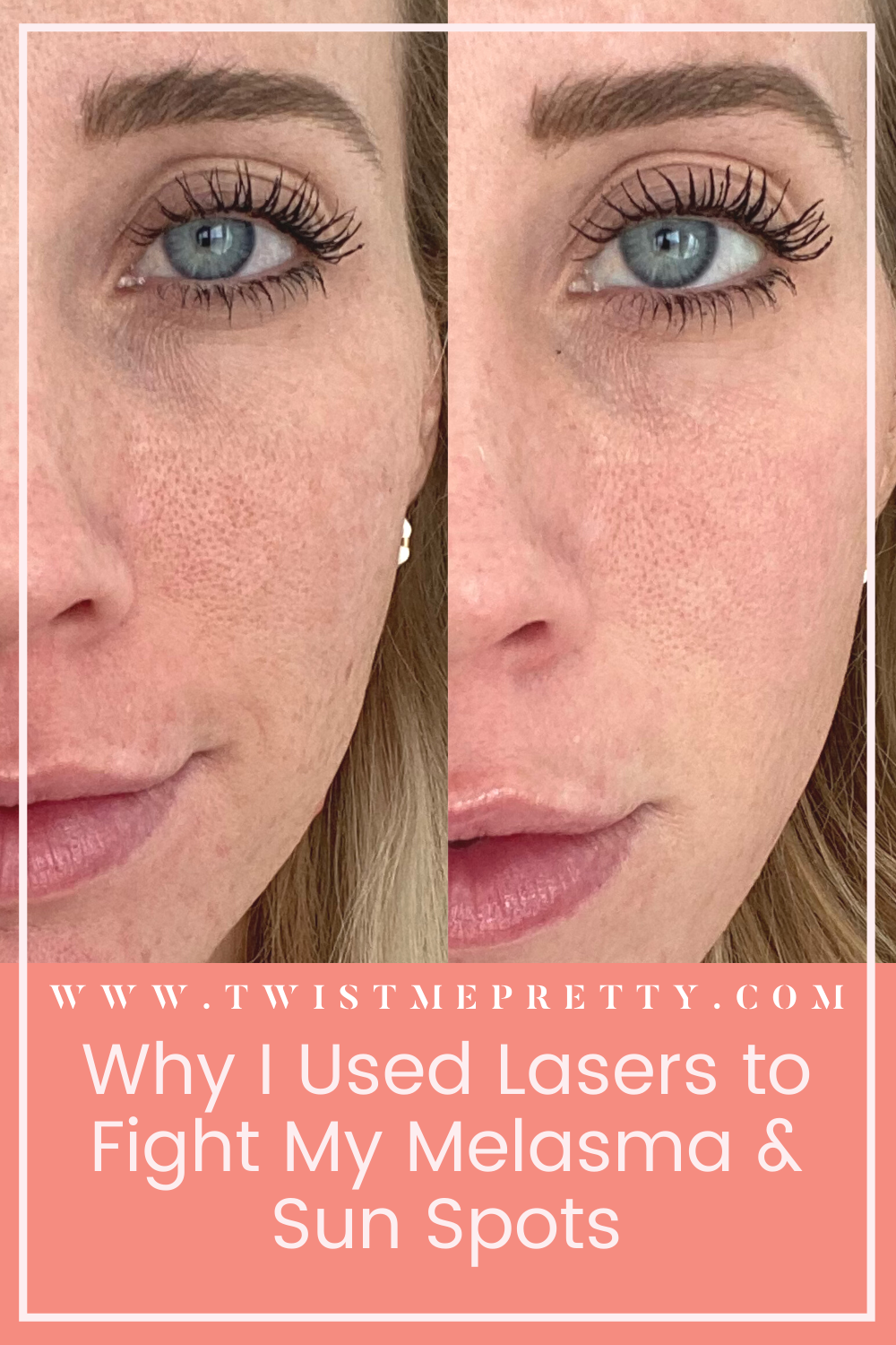 Treating Melasma with The Light and Bright Laser Twist Me Pretty