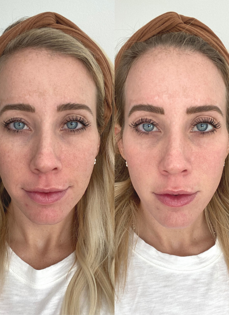 Treating Melasma with The Light and Bright Laser Twist Me Pretty
