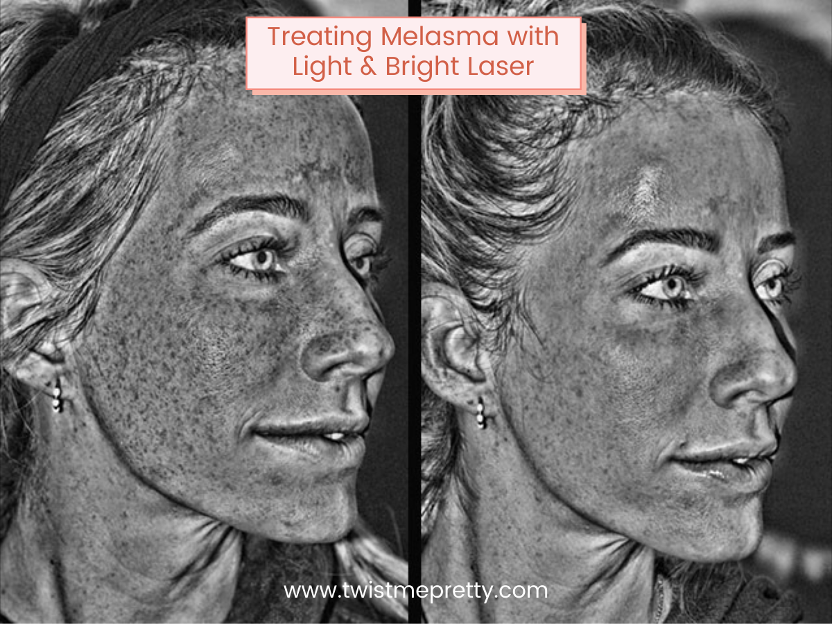 How I am treating my melasma with the Light and Bright Laser from Gateway Laser Center www.twistmepretty.com